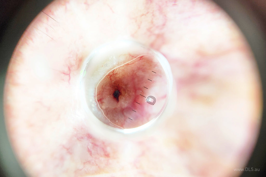 Contact plate with a small 10mm diameter  during use