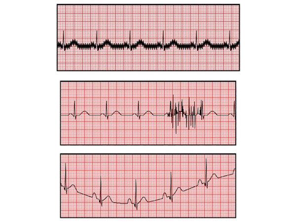 ECG Waveform Interference